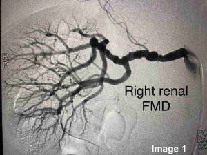 Renal Artery Fibromuscular Dysplasia Advanced Heart And Vein