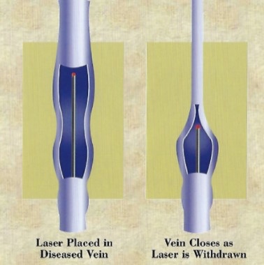 Laser Varicose Vein Surgery