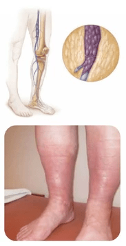 Deep Vein Thrombosis