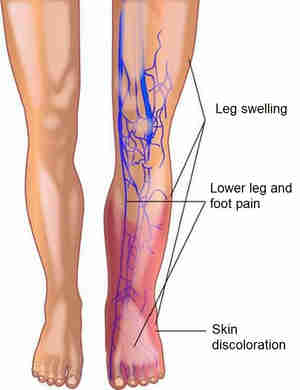 Deep Vein Thrombosis: Symptoms, Causes & Treatment